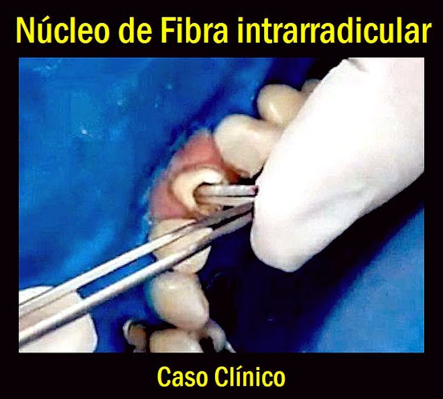 PINOS DENTÁRIOS: Núcleo de Fibra intrarradicular - Caso Clínico