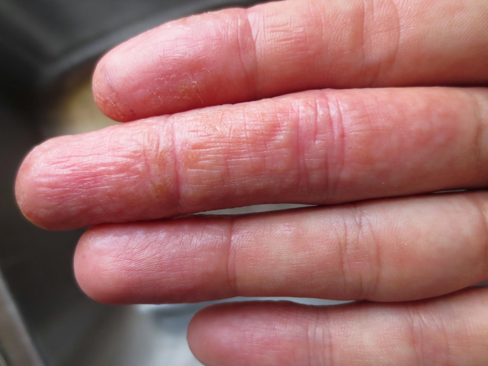 SKIN DISEASE TYPES: Vesicular Hand Dermatitis (Skin Disease type)