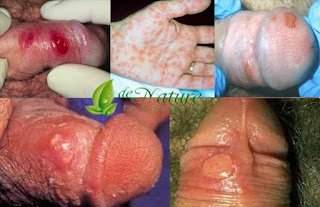 Sipilis Disebabkan Oleh Apa dan Kenapa Penis Luka Lecet