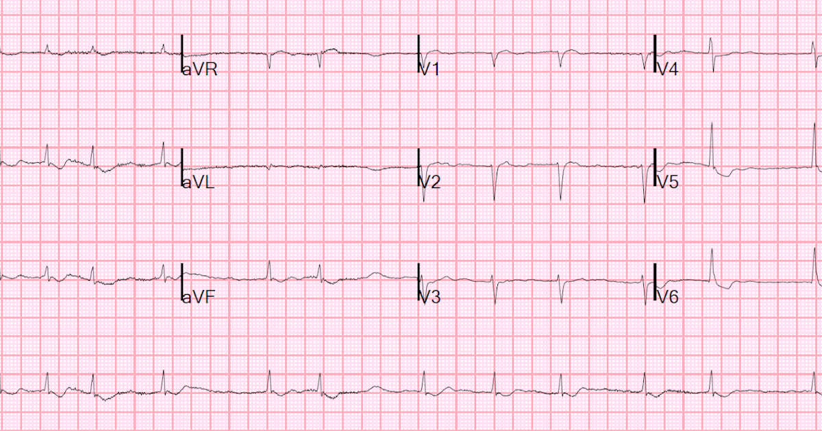 Dr. Smith's ECG Blog Is this ST depression due to "lateral ischemia"?