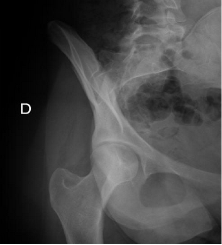 Tecnicos Radiologos: Fractura de Pelvis y de Cadera (todas las ...