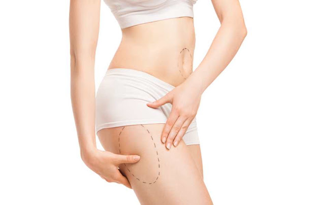 What You Need To Know About Liposuction