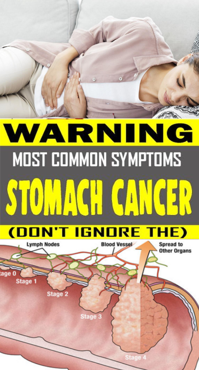 Quiet, But Severe Killer: Cancer Of The Colon First Shows These 6