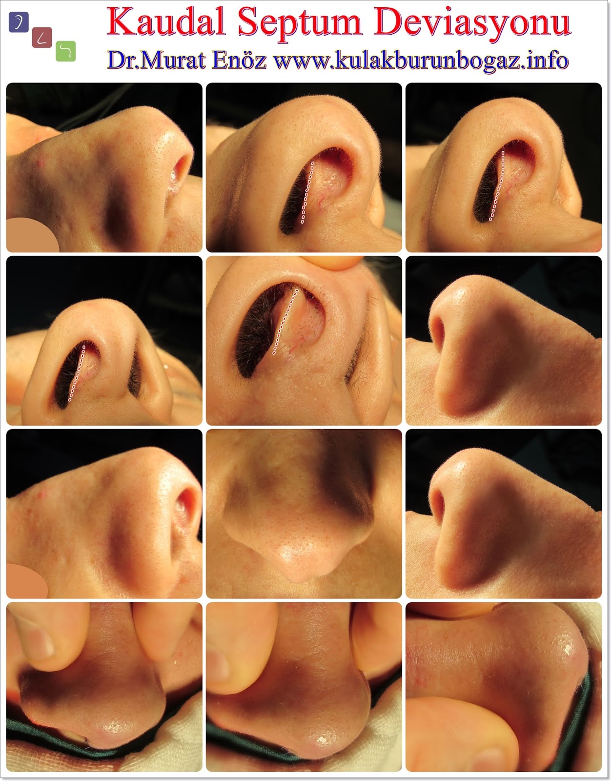 праведбний прокол септум. правильный прокол септума схема. микробанан пирсинг в нос септум. как колоть септум схема. септум куда колоть.