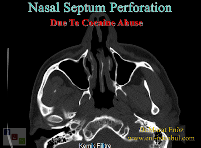 Nasal Septum Perforation Due To Cocaine Abuse