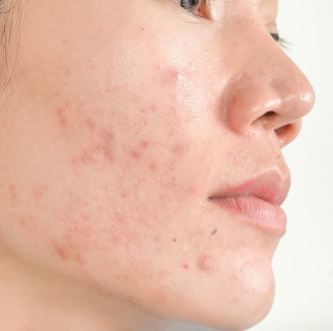Health and Fitness -   Acne