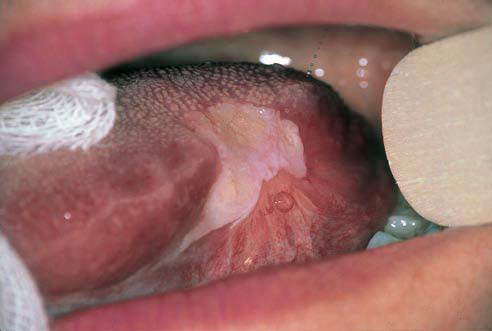 White plaques on the mucosa of the mouth - Answers.com