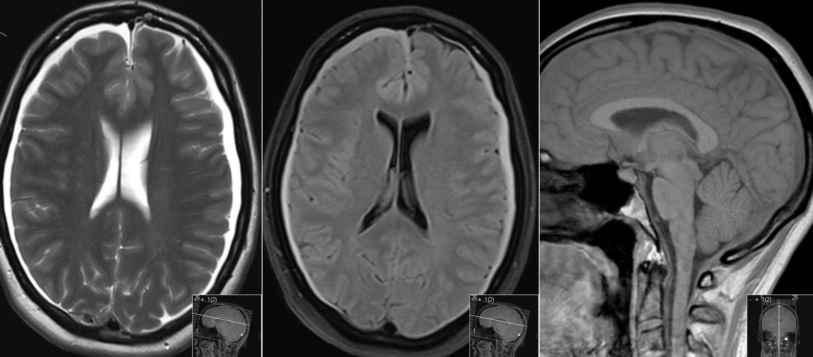 cerebrospinal fluid leak in brain after head trauma cerebrospinal fluid leak in brain after head trauma