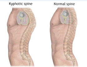 Exercise and Posture: Kyphosis