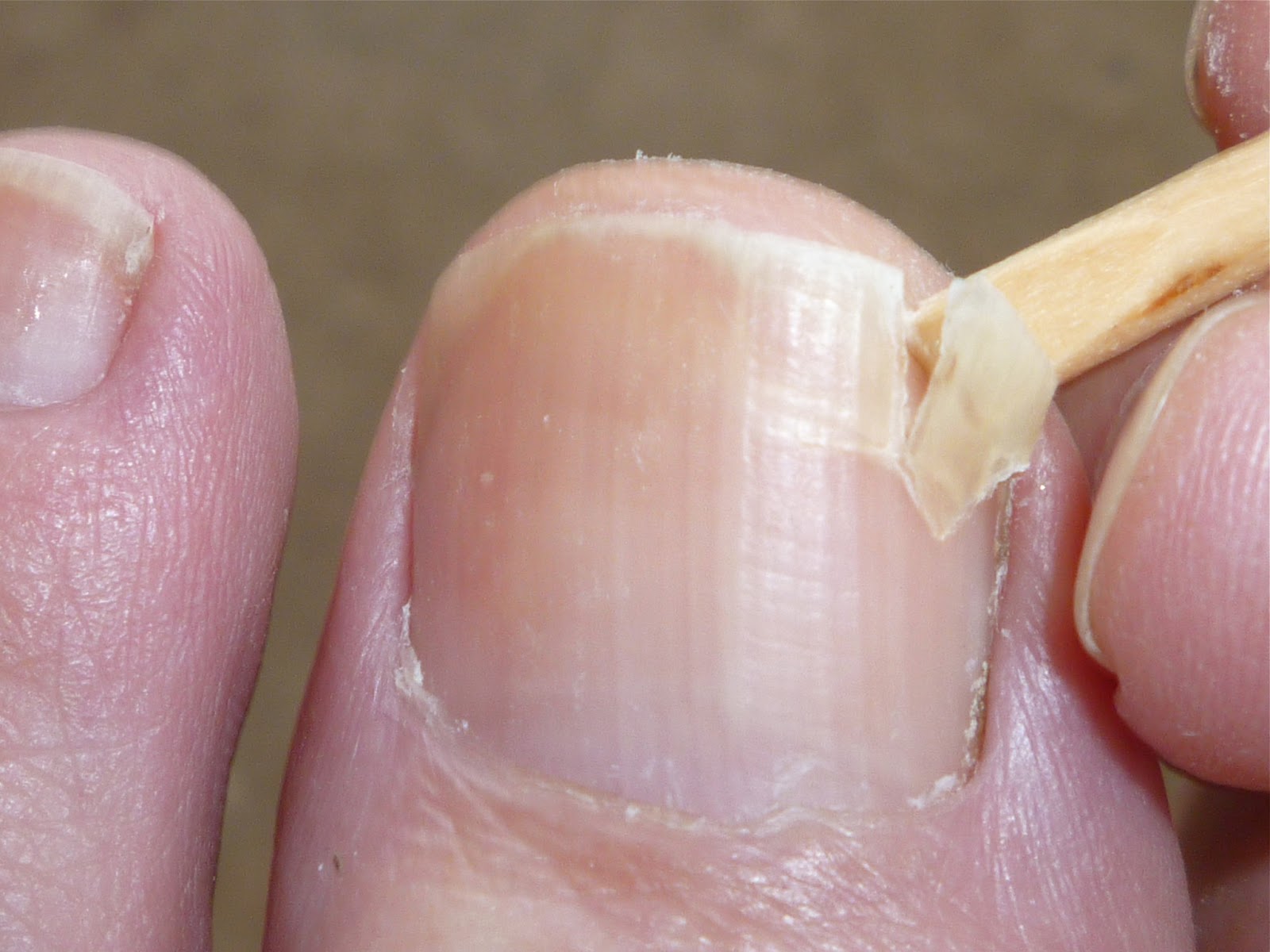 fingernail separated from nail bed #10