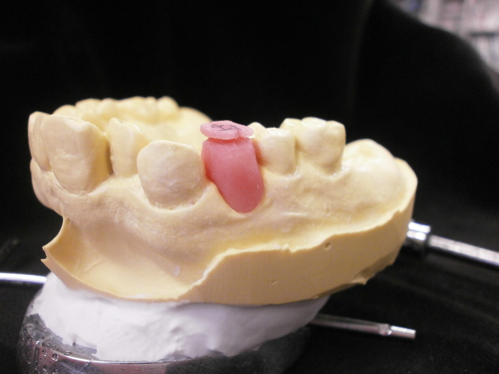 髙田朝（Hajime Takada）のオーダーメイド歯科技工物の紹介 Introduction of custommade dental