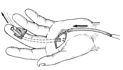 шов сухожилия сгибателей кисти. чрескостный шов пальца кисти сухожилия сгибателя. пластика сухожилия сгибателя 1 пальца кисти. пластика сухожилий сгибателей пальцев кисти. Musculus abductor digiti minimi.