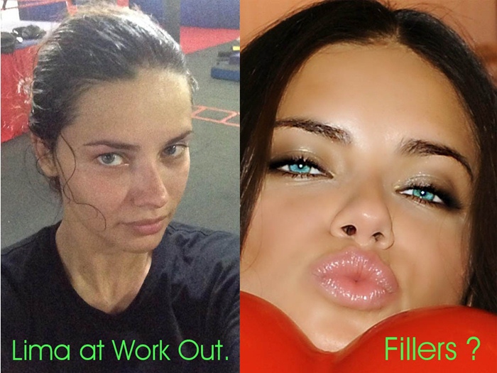 Adriana Lima Surgery.