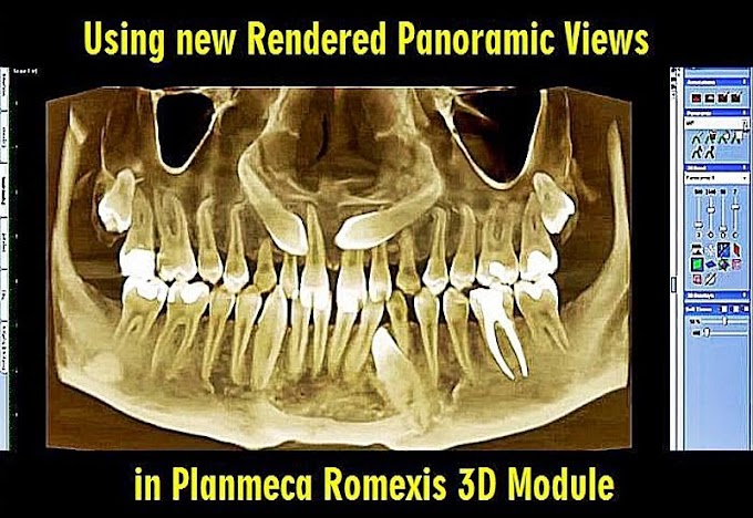 DENTAL RADIOGRAPHY: Using new Rendered Panoramic Views in Planmeca Romexis 3D Module