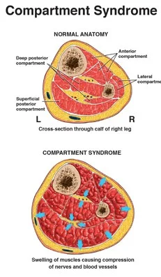 What is Compartment Syndrome?
