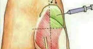 Иглы для внутримышечных инъекций в ягодицу. Постинъекционный абсцесс. Как поставить укол в ягодицу в домашних условиях взрослому. Схема как колоть уколы в ягодицу. Кпк прпвилтго мтпатть укол.