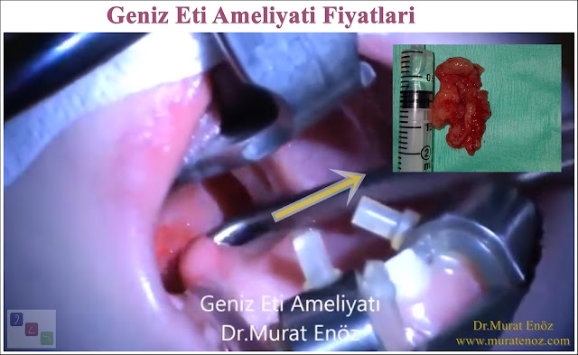 Geniz Eti Ameliyatı Fiyatları 2021 (Güncellendi)