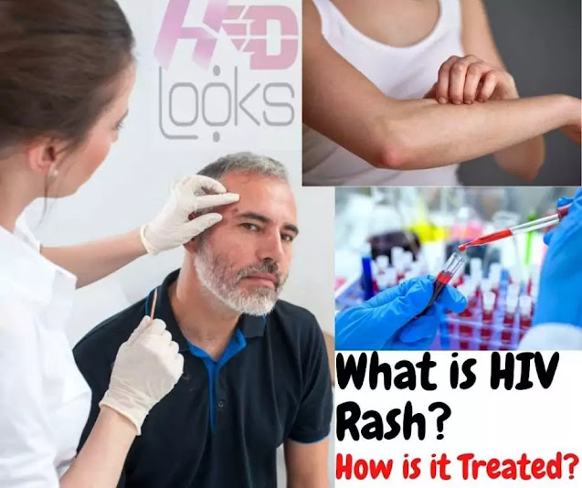 HIV Rash HIV Rash