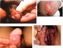 Sipilis