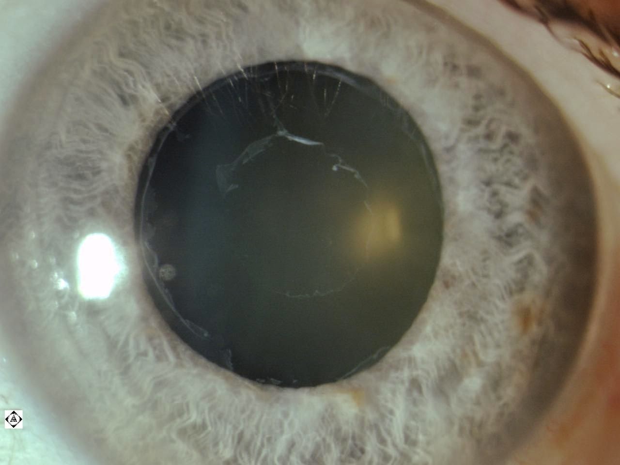 PSEUDOEXFOLIATION Sonoran Desert Eye Center