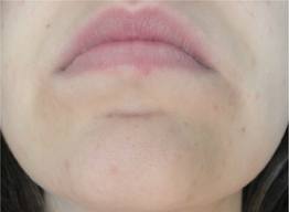 hyperpigmentation around mouth treatment
