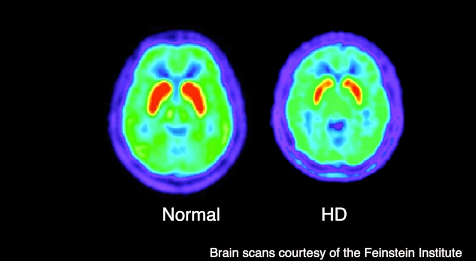 Huntington Disease Huntington Chorea Juvenile Huntington Disease Huntington Disease Huntington Chorea Juvenile Huntington Disease