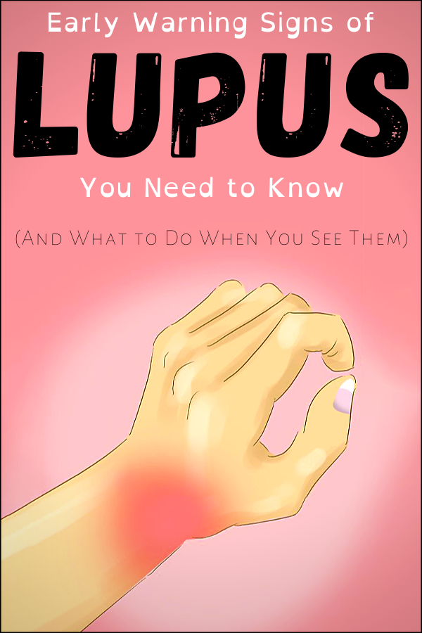 Early Warning Signs of Lupus You Need to Know (And What to Do When You