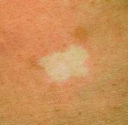 Ash Leaf Spots Facts And Overview Health Digest