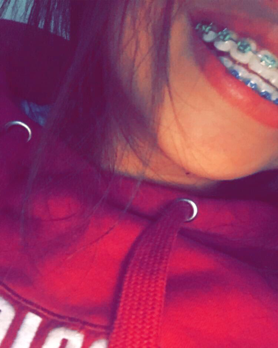 Arriba 101+ Foto Aplicacion Para Poner Brackets En Fotos Actualizar 09/2023