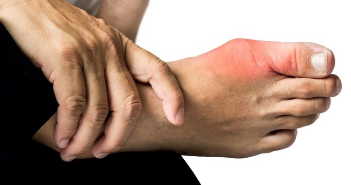 50 Cara Atasi Penyakit Gout  Seputar Viral