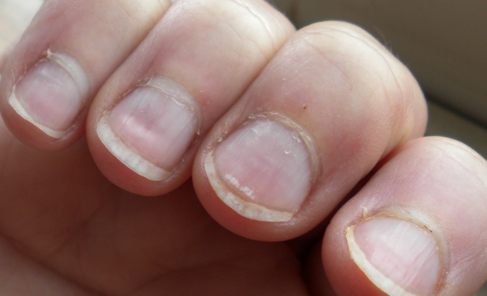 If you have dents in your nails that look like they were made by an icepick
