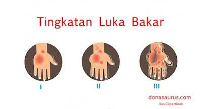 donasaurus.com Luka bakar