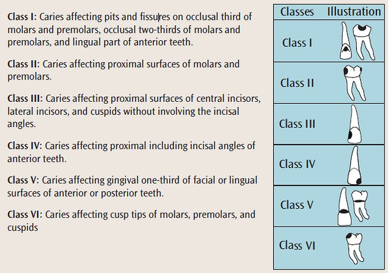 PDF Dental Caries definition, classification and etiology