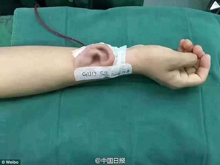 Shocking!!! Doctor Grows New Ear on a Man's Arm to Restore His Hearing After He Lost it in a Tragic Accident (Photos)