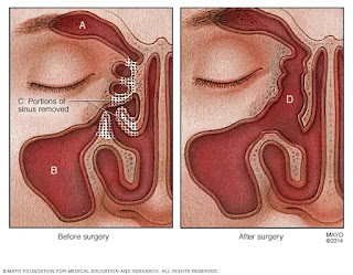 Cirugía de Senos Paranasales y frontales Sinusitis crónica