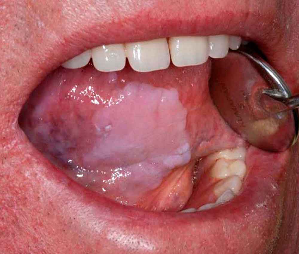 A guide to common oral lesions