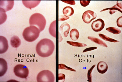 A. Sel-sel darah merah normal, B. Sel-sel darah merah sabit