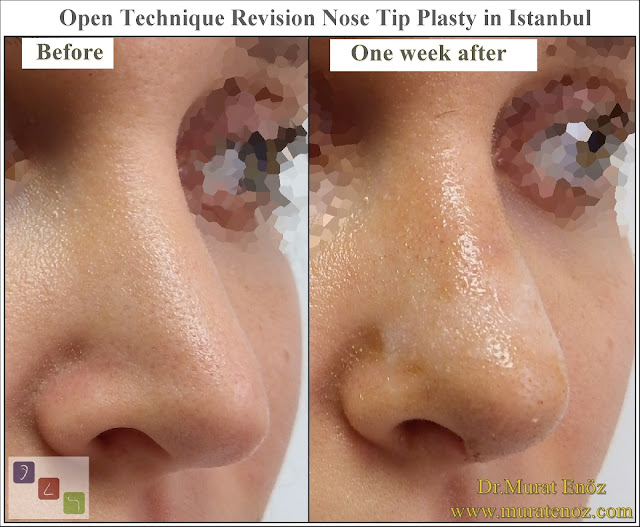 Open technique revision nose tip plasty operation