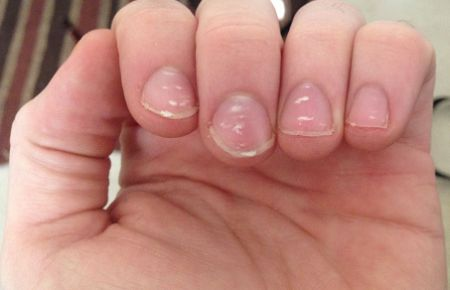 Question about nails : r/PsoriaticArthritis