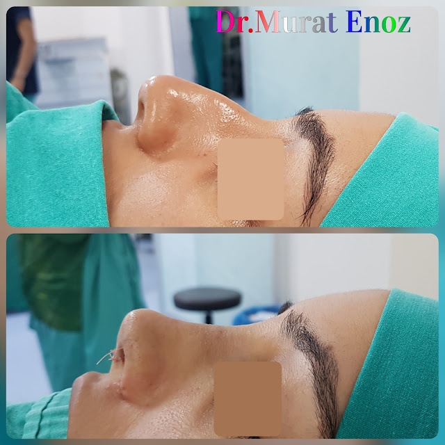 thick skinned nose aesthetic, nose job for women, rhinoplasty operation in istanbul, femal nose job, ethnic rhinoplasty, nose job for thick skinned nose, rhinoplasty in istanbul