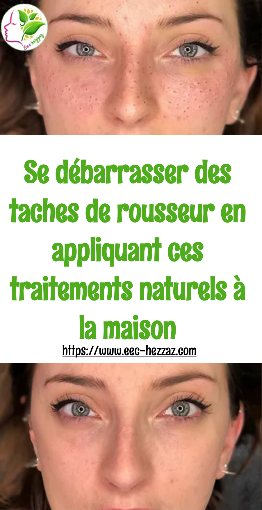 Se débarrasser des taches de rousseur en appliquant ces traitements naturels à la maison