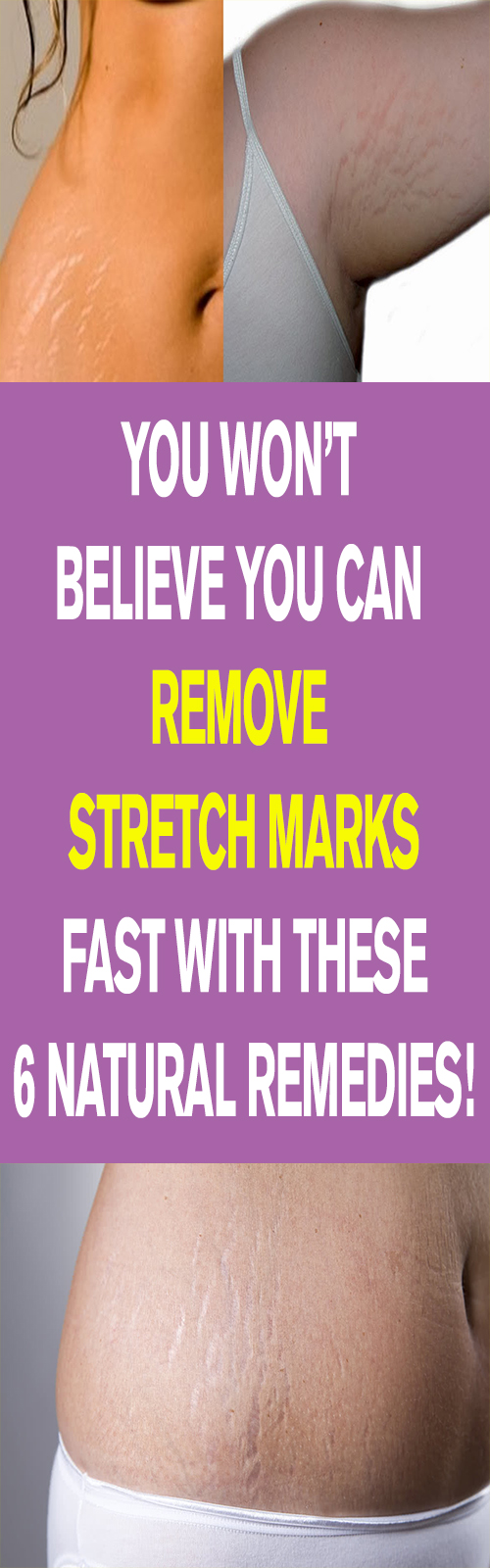 365 AIMS YOU WON’T BELIEVE YOU CAN REMOVE STRETCH MARKS FAST WITH
