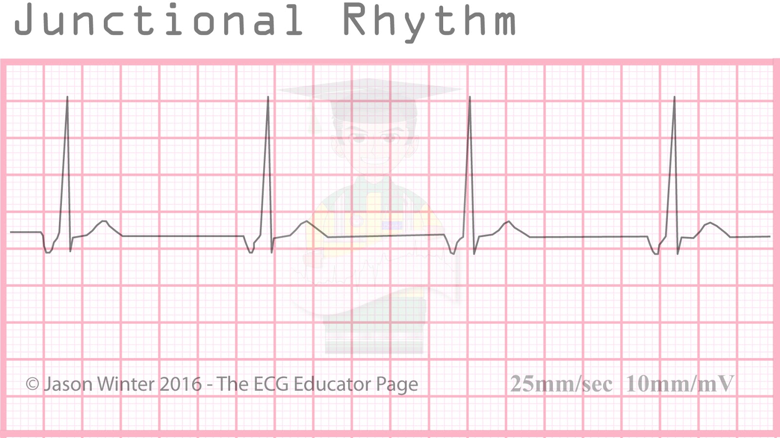junctional escape rhythm diagram