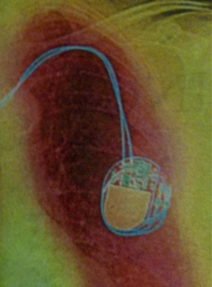 Suburban spaceman Recycled Pacemakers Safe for use in developing world