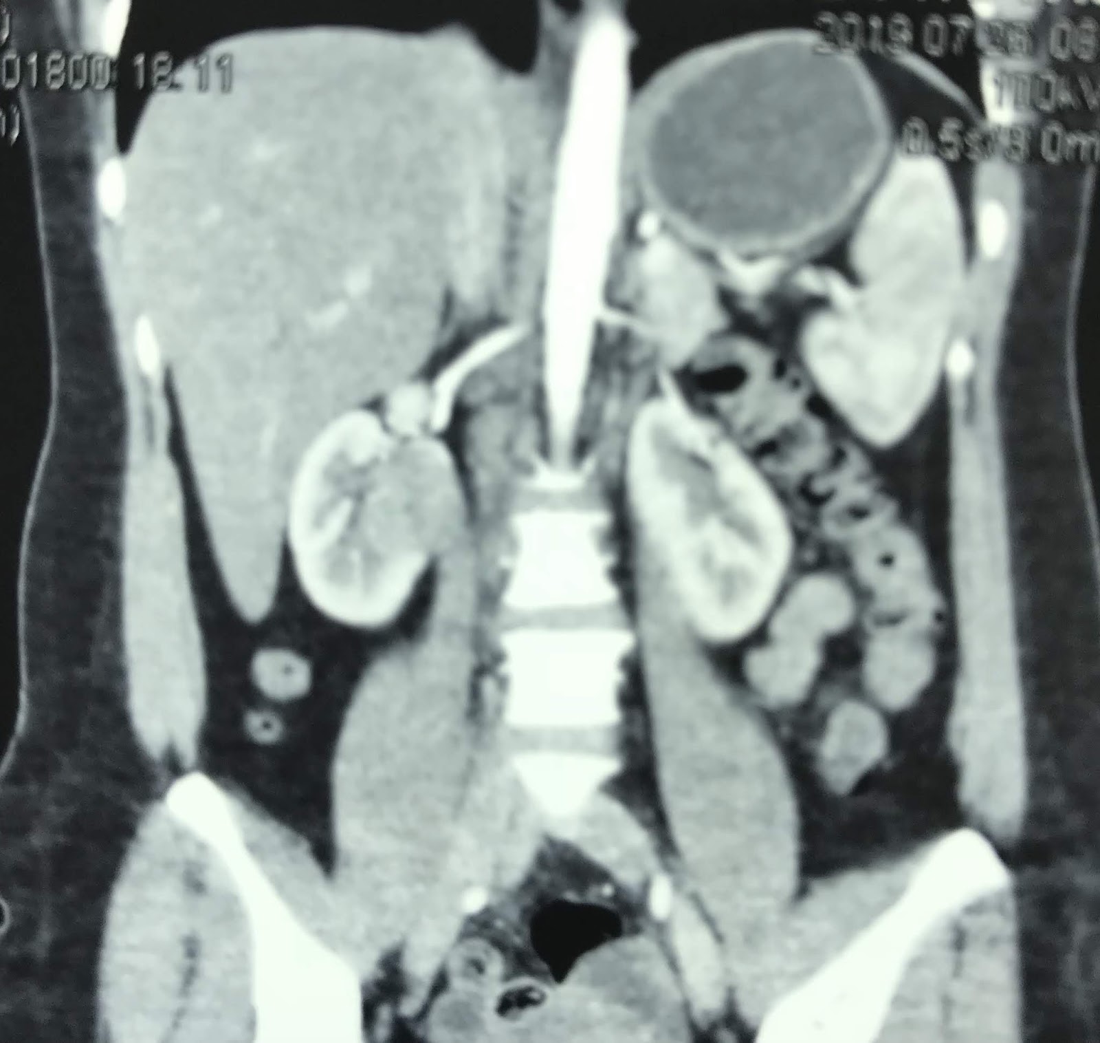 VIETNAMESE MEDIC ULTRASOUND CASE 560 TUMOR IN HORSESHOE KIDNEY, Dr