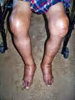 गठिया रोग का उपचार गठिया रोग का उपचार