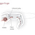 Cara Tradisional Mengobati Trigger Finger