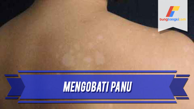 Cara Menghilangkan Panu Secara Permanen dengan Bahan Alami Cara Menghilangkan Panu Secara Permanen dengan Bahan Alami