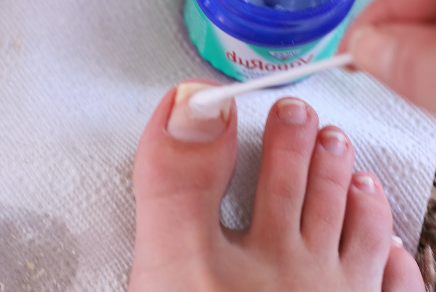 снимать ноготь ребенку