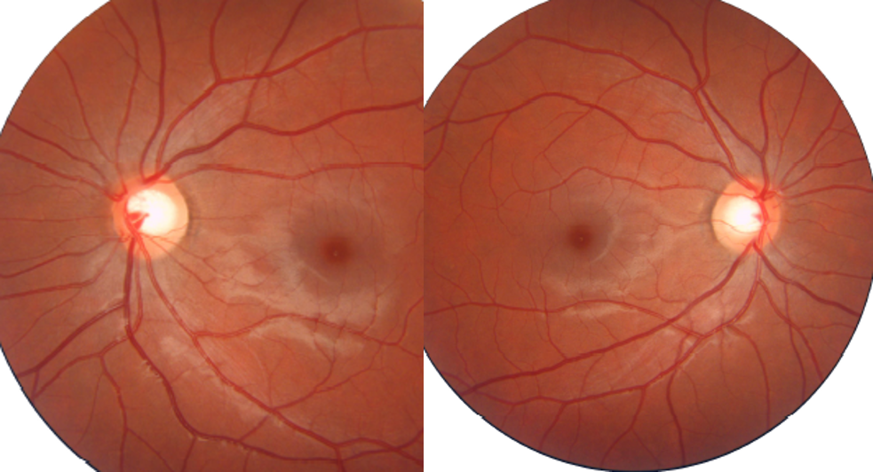 Retina e Catarata Fortaleza Nervo Óptico Retina e Catarata Fortaleza Nervo Óptico